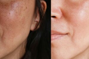 Dark Spots