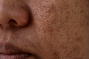 Melasma